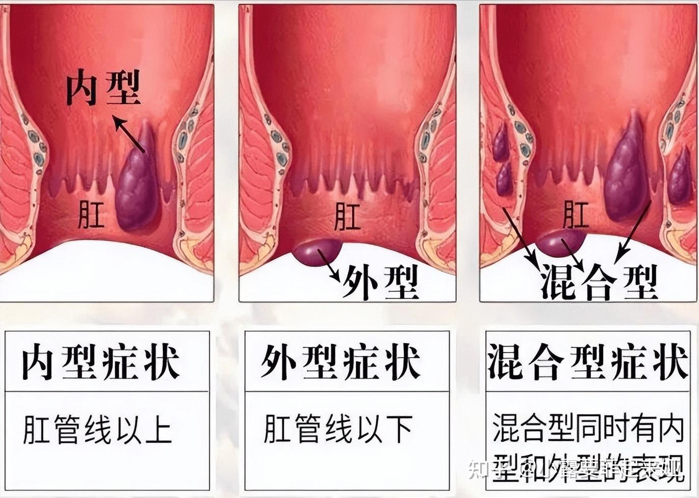 痔疮是怎么回事？怎么治？