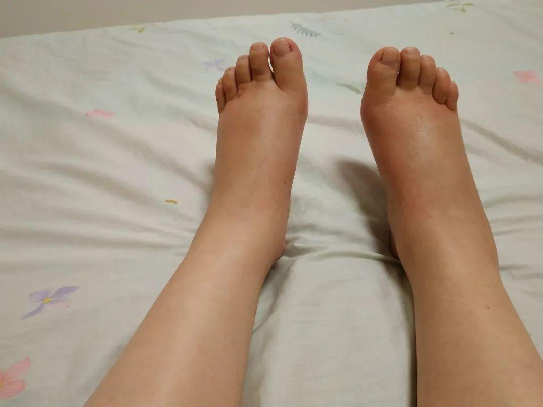 女生脚肿的图片,女生崴脚受伤真实图片 - 伤感说说吧