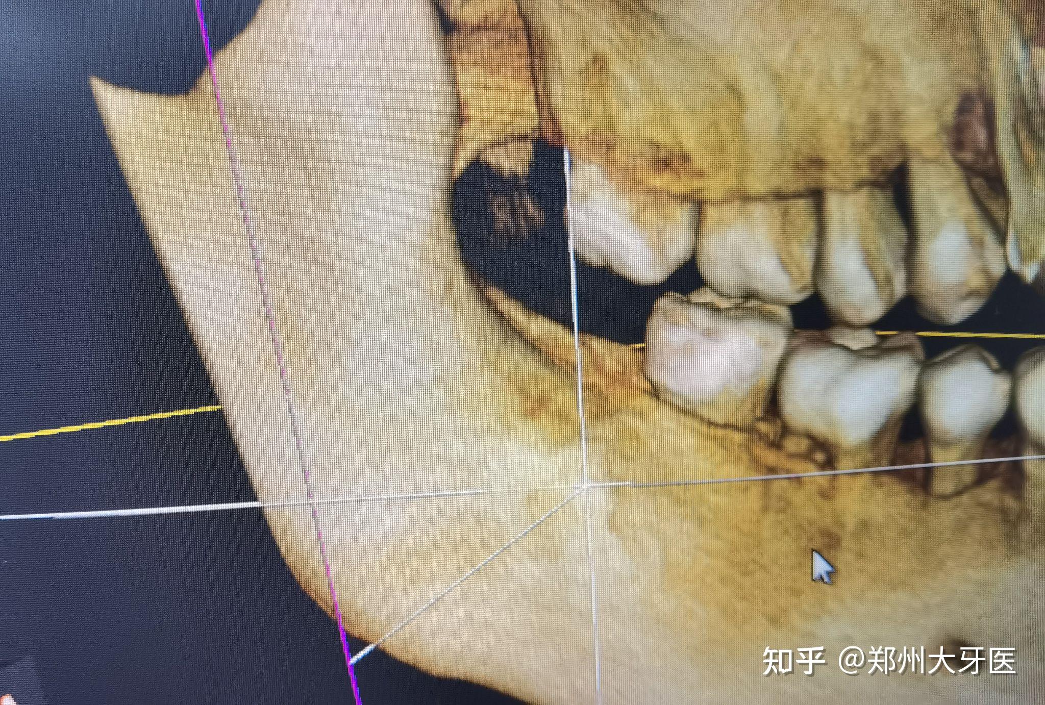 拔智齿牙槽骨突出图片