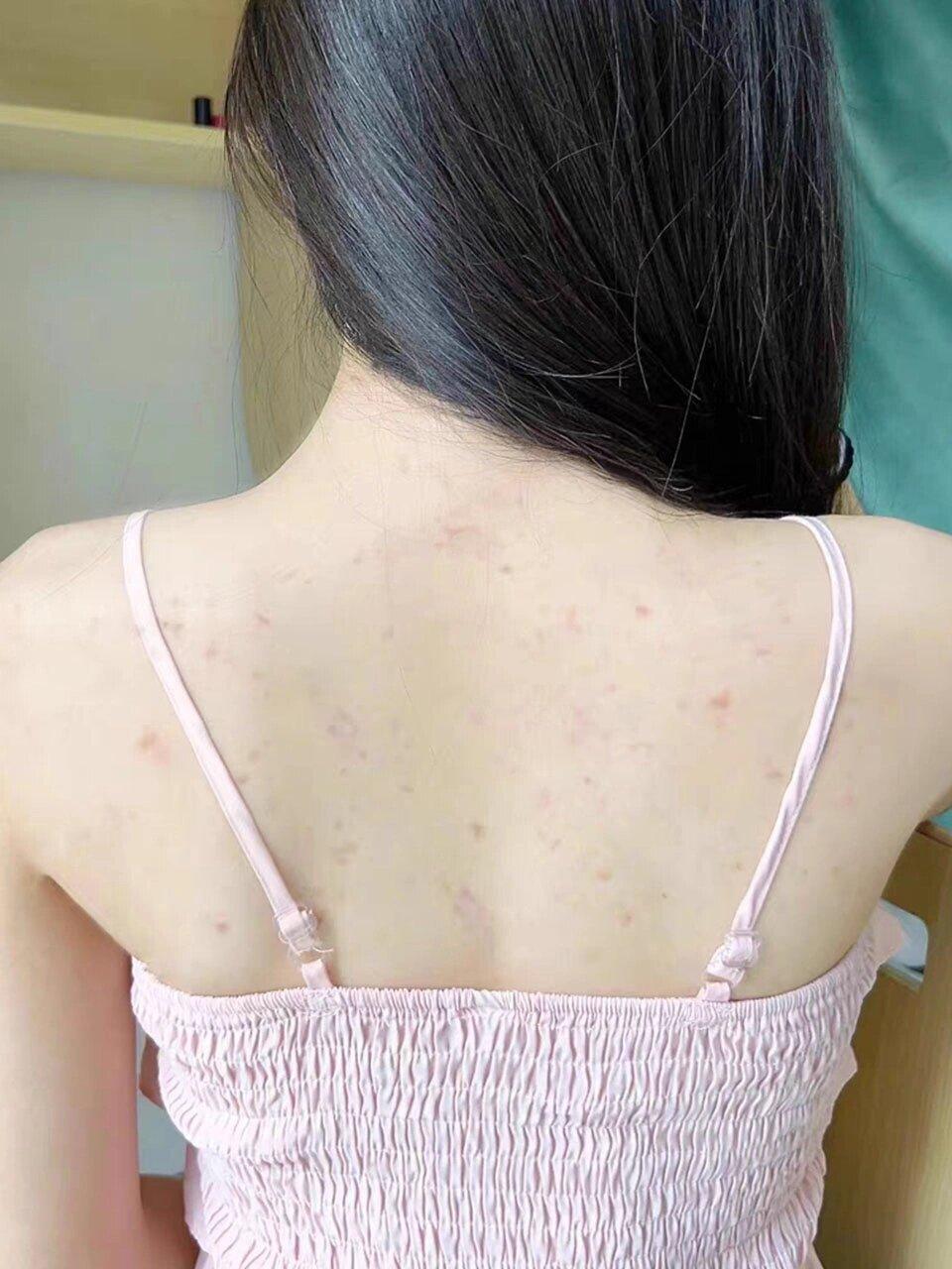 背后有痘痘是什么引起的 v2-7ac88711e05ba79f9c9e2cc4aa097da6_r.jpg