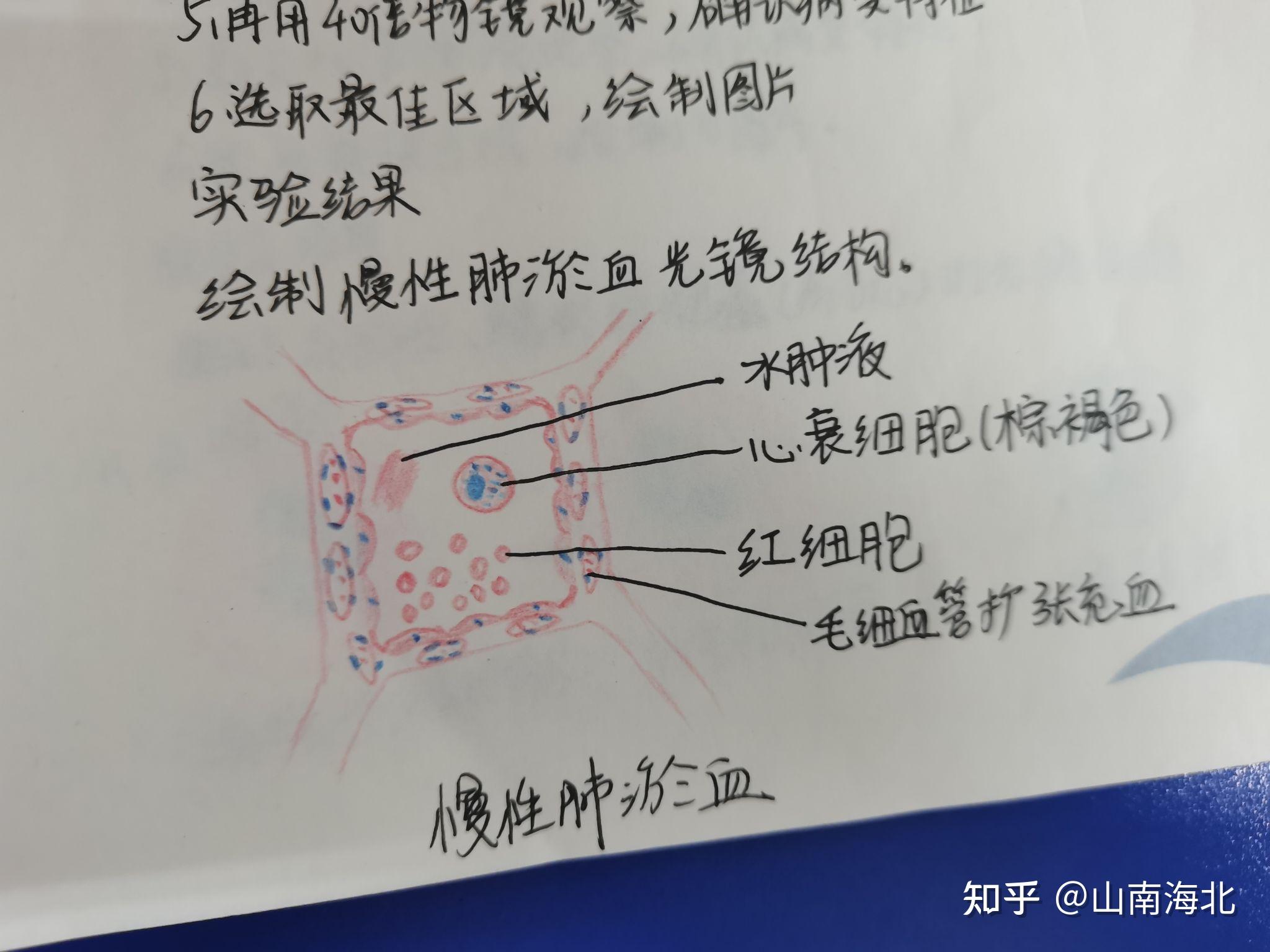 细胞水肿脂肪变性肉芽组织肺瘀血炎细胞鳞状细胞癌动脉粥样硬化大叶性