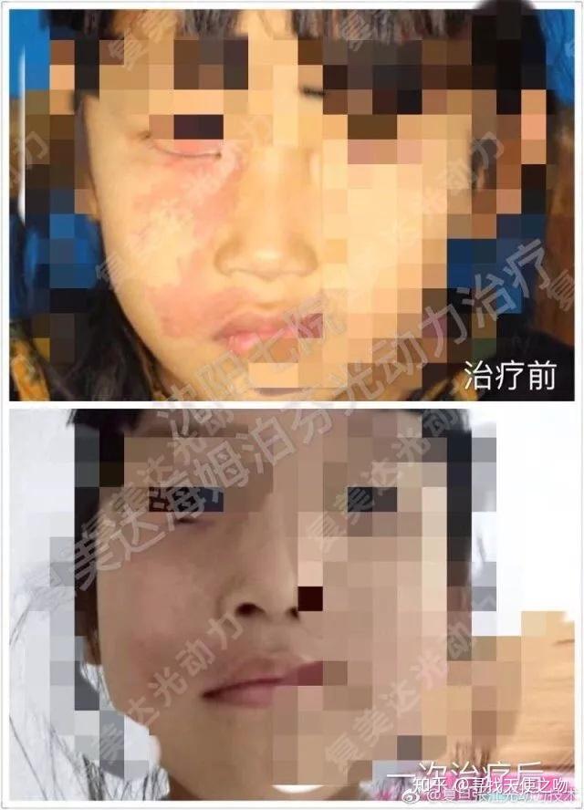 鲜红斑痣治疗痊愈病例展示部分暑假治疗利于术后恢复