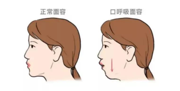 下巴就显得越来越短上颌骨变长,下颌后缩口呼吸时腭穹隆高拱妨碍了