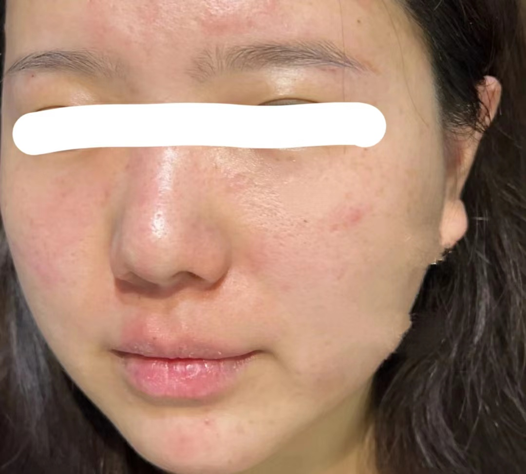 敏感肌脸泛红有什么好用到爆的护肤品推荐？ - 知乎