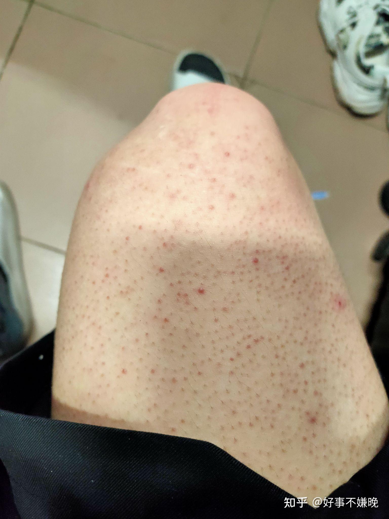 后背长成片鸡皮疙瘩(后背长成片鸡皮疙瘩图片)
