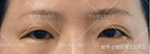 双眼皮修复十问十答 知乎
