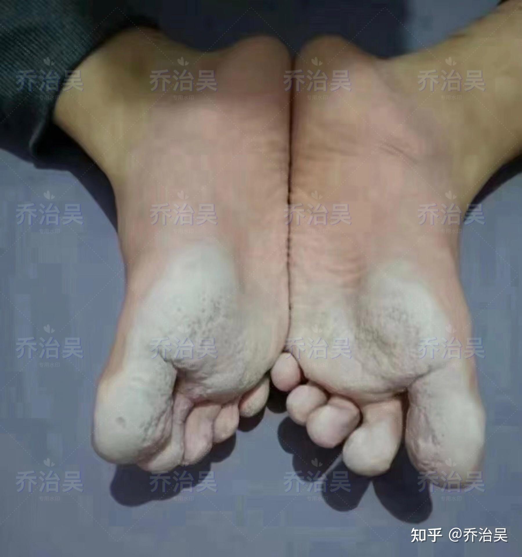 四,分享一个特别的足部问题,奇臭无比!