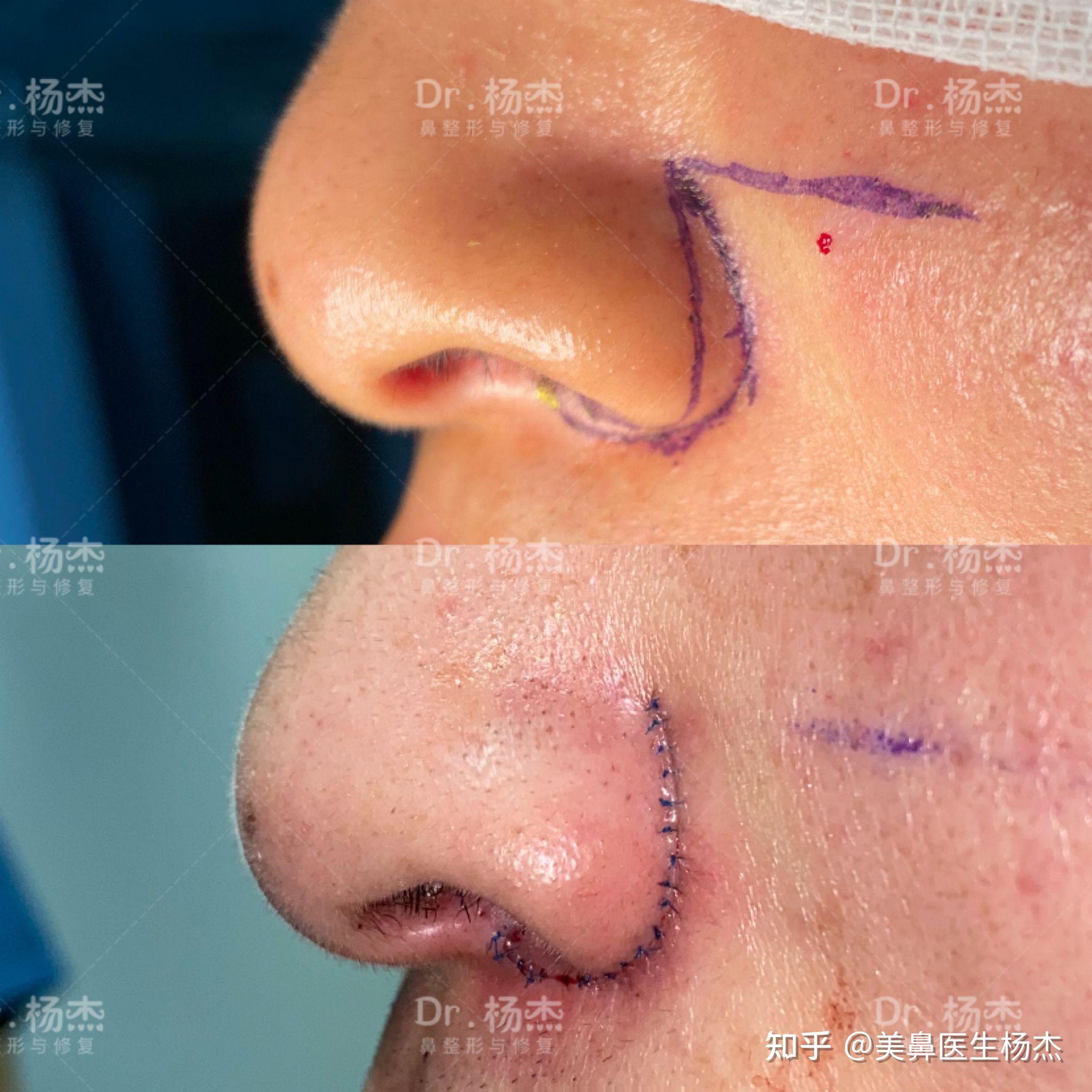 鼻翼缩小手术真的有效果吗