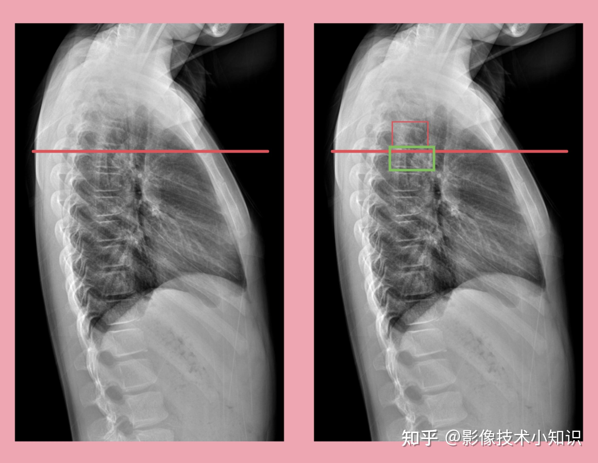 第三胸椎图片