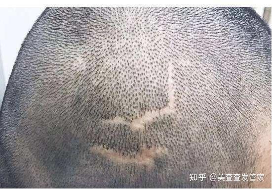 植发跟真发的区别(植发是植真发还是假发)