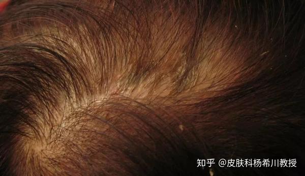 必知:脂溢性皮炎详细攻略 - 知乎