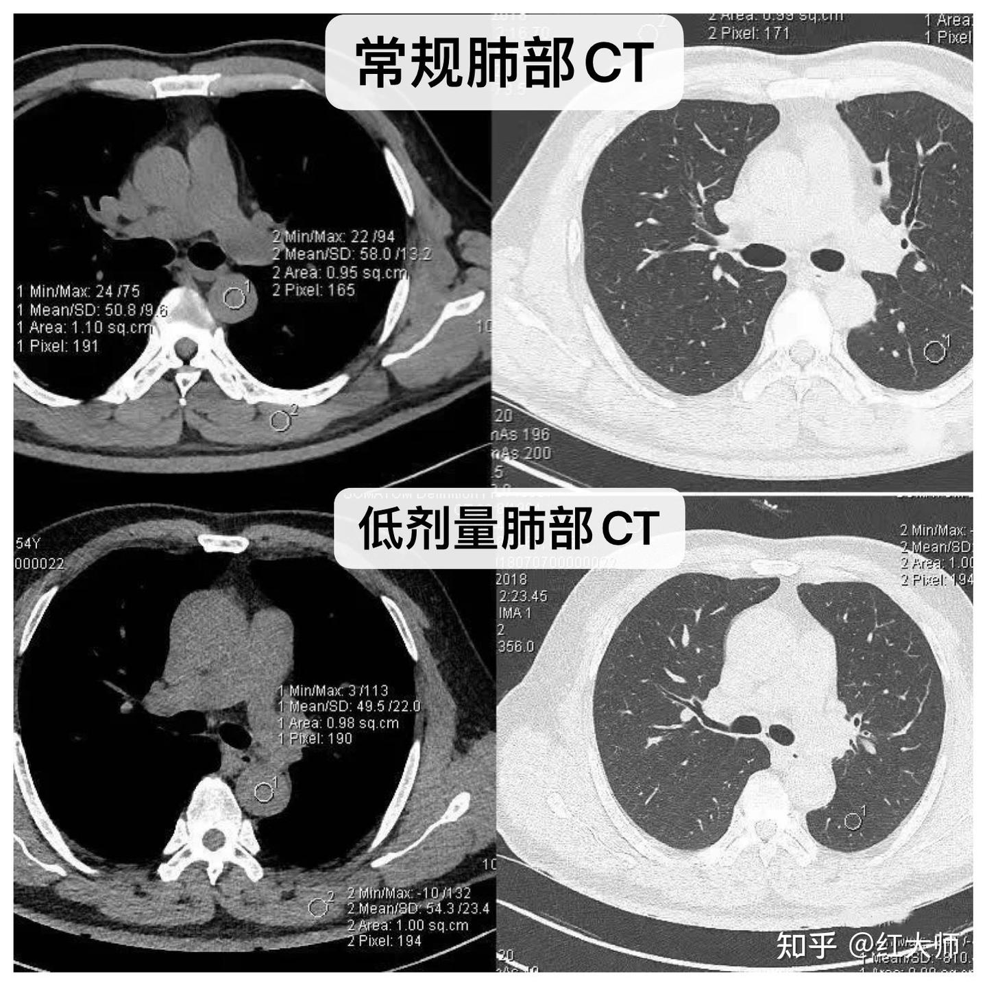 关于低剂量肺部CT的真相 - 知乎