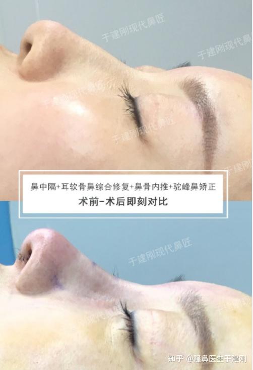 什么是鼻骨内推什么情况下可以选择鼻骨内推手术