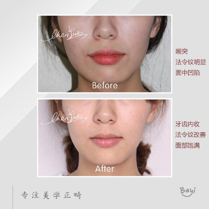 矫正前后面部对比