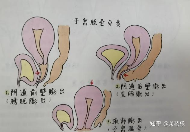 多图看懂子宫下垂阴道膨出到底多严重