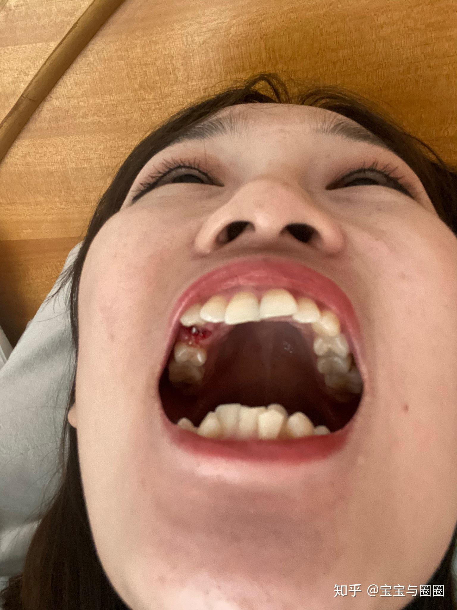 正畸单侧拔除上下4号牙有成功的吗