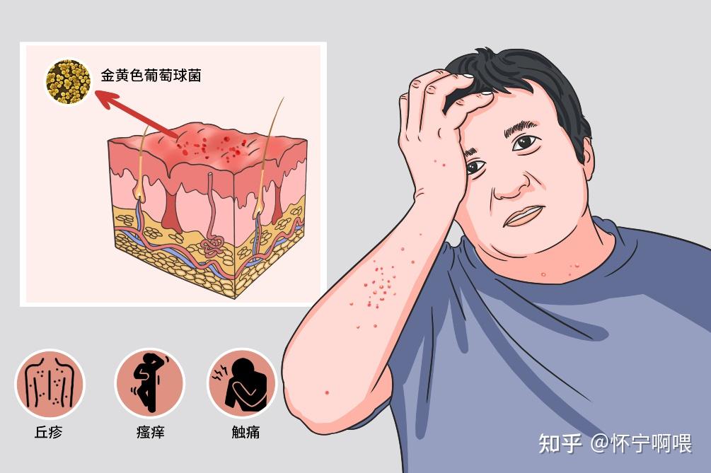 毛囊炎怎么办?一文看懂毛囊炎到底是什么病!含用、药、指、南 - 知乎