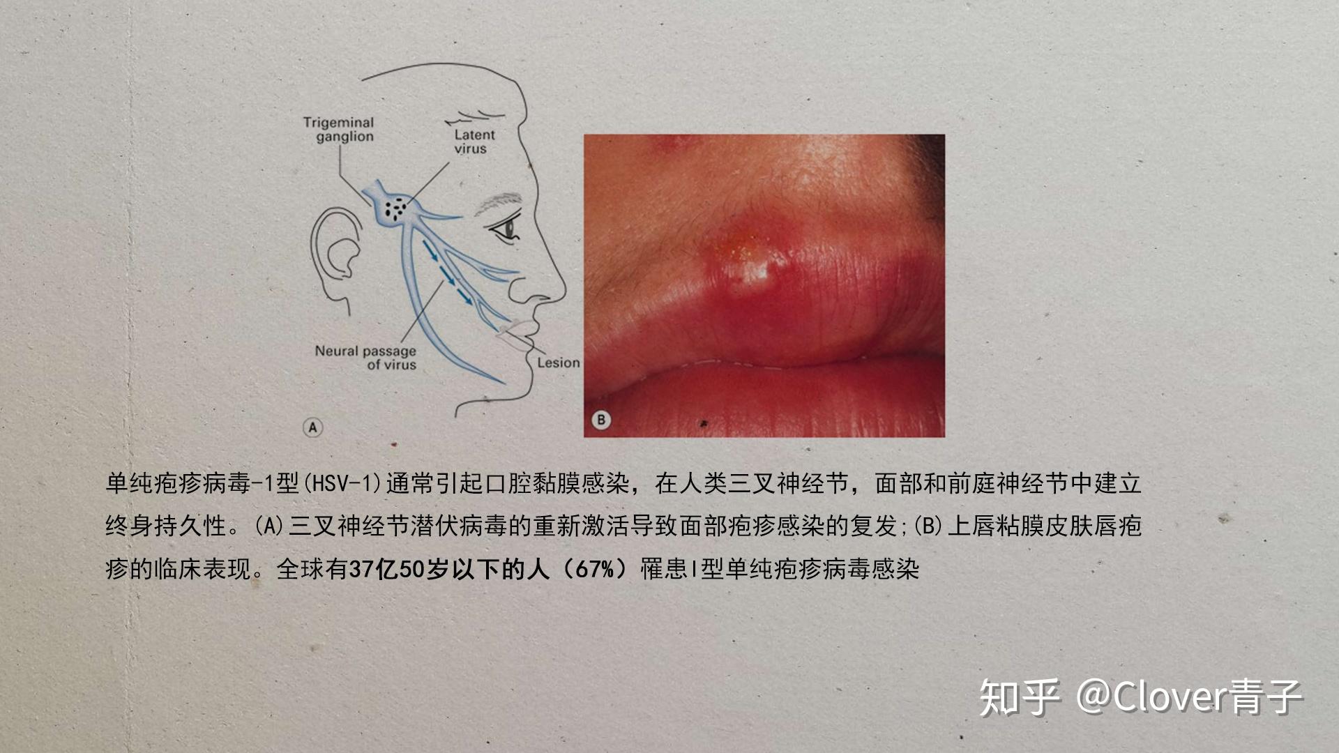 单纯疱疹病毒