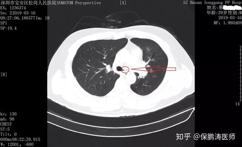 一咳嗽就是支氣管炎究竟什麼才是支氣管炎