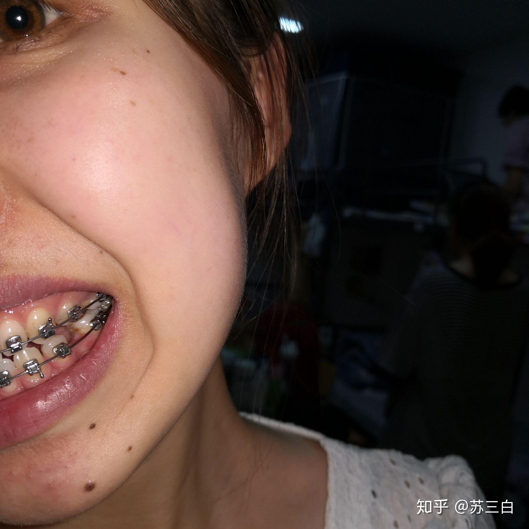 骨性嘴凸,牙齿矫正,上海口腔病防治院