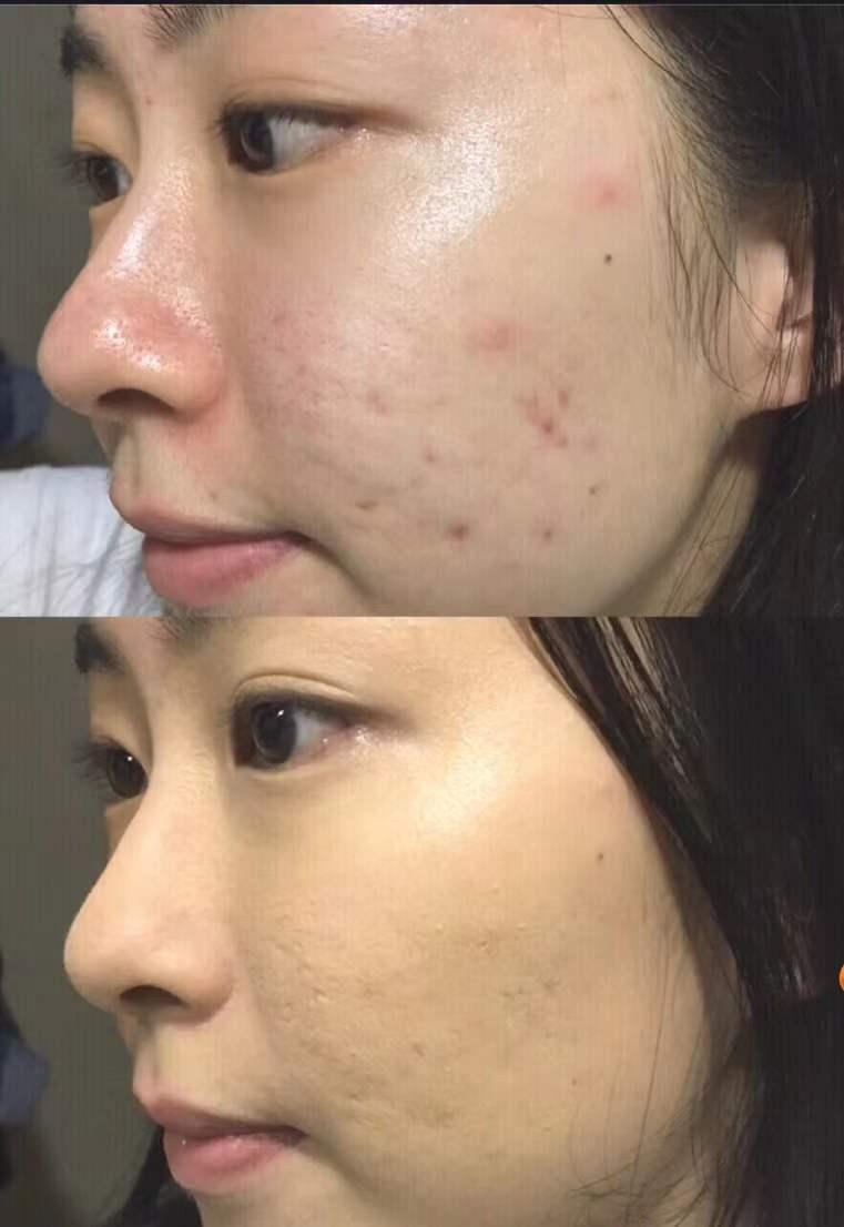 祛痘,改善毛孔等效果,找了一些优秀的案例分享,都是真人亲测反馈,姐妹