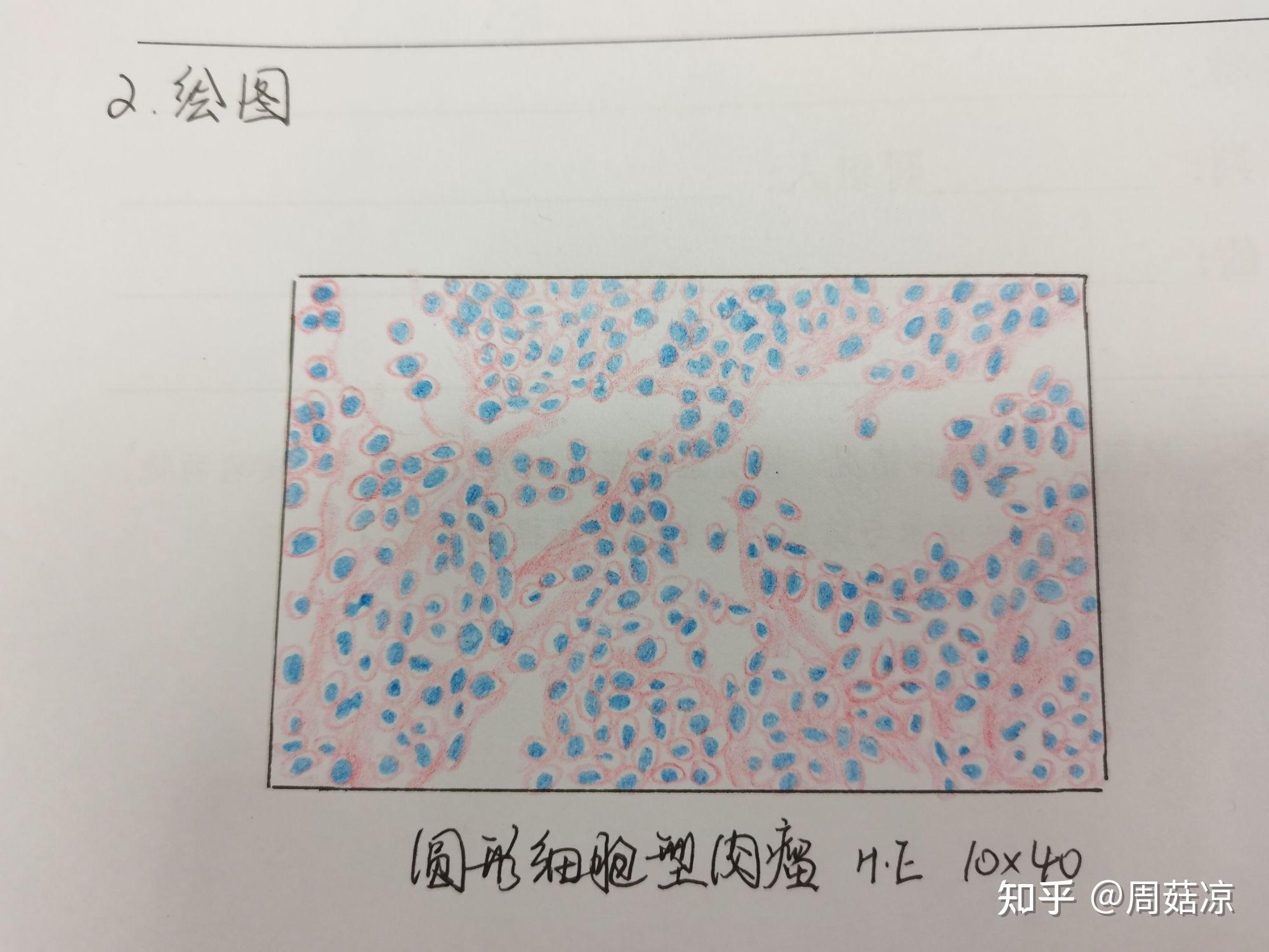 病理学  肿瘤手绘图