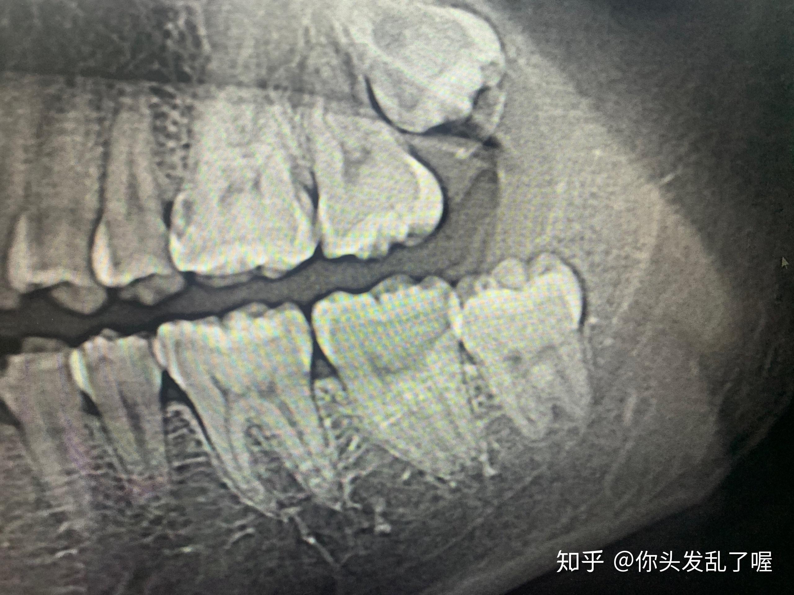 想问一下你们压到神经的智齿多少钱拔的有没有什么后遗症