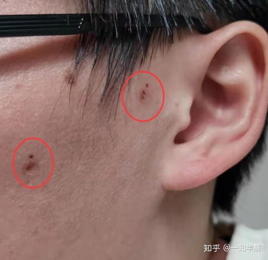 中医院激光点痣全程记录