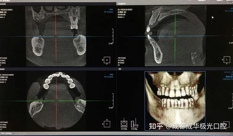 牙周炎拍片解析图图片
