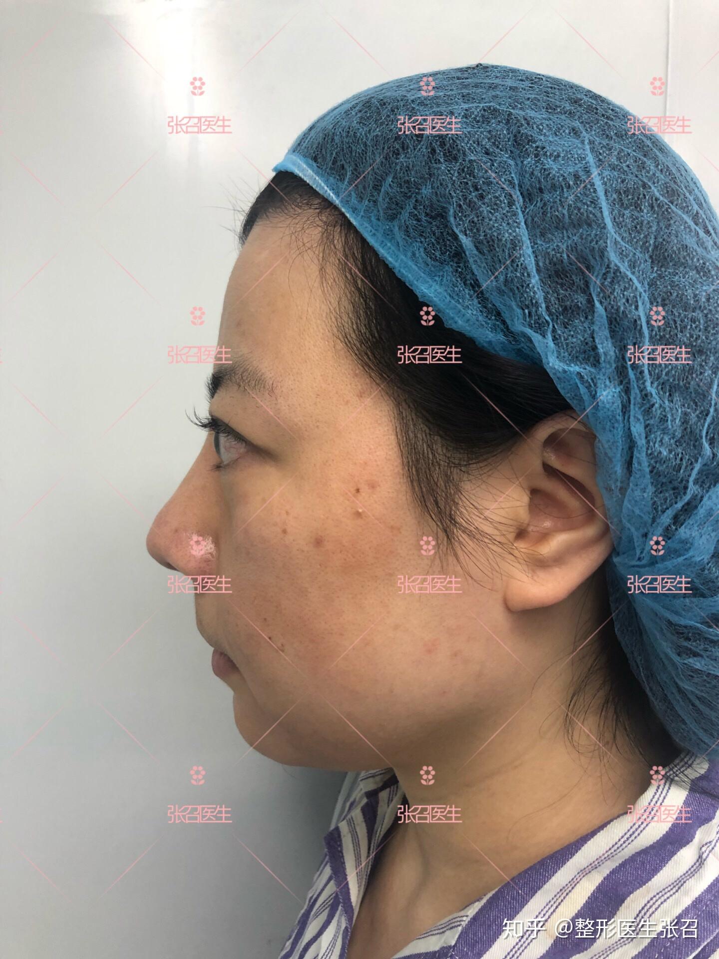 假体能丰额头吗?