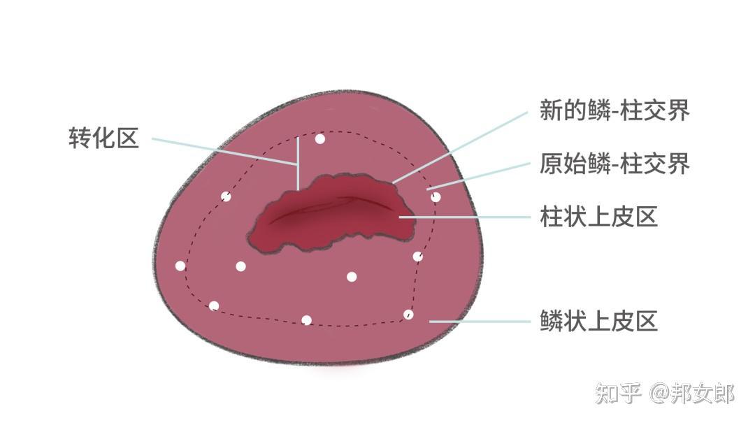 宫颈转化区2型图片图片