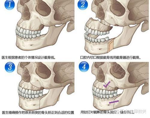 颌面整形能改善我们的哪些问题? - 知乎