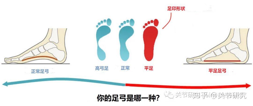 成年人要学会低几次头看看自己有没有扁平足