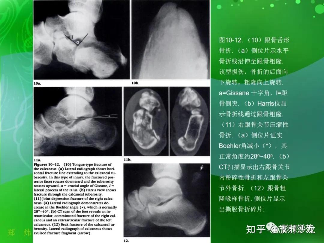 跟骨正常与变异影像表现 - 知乎