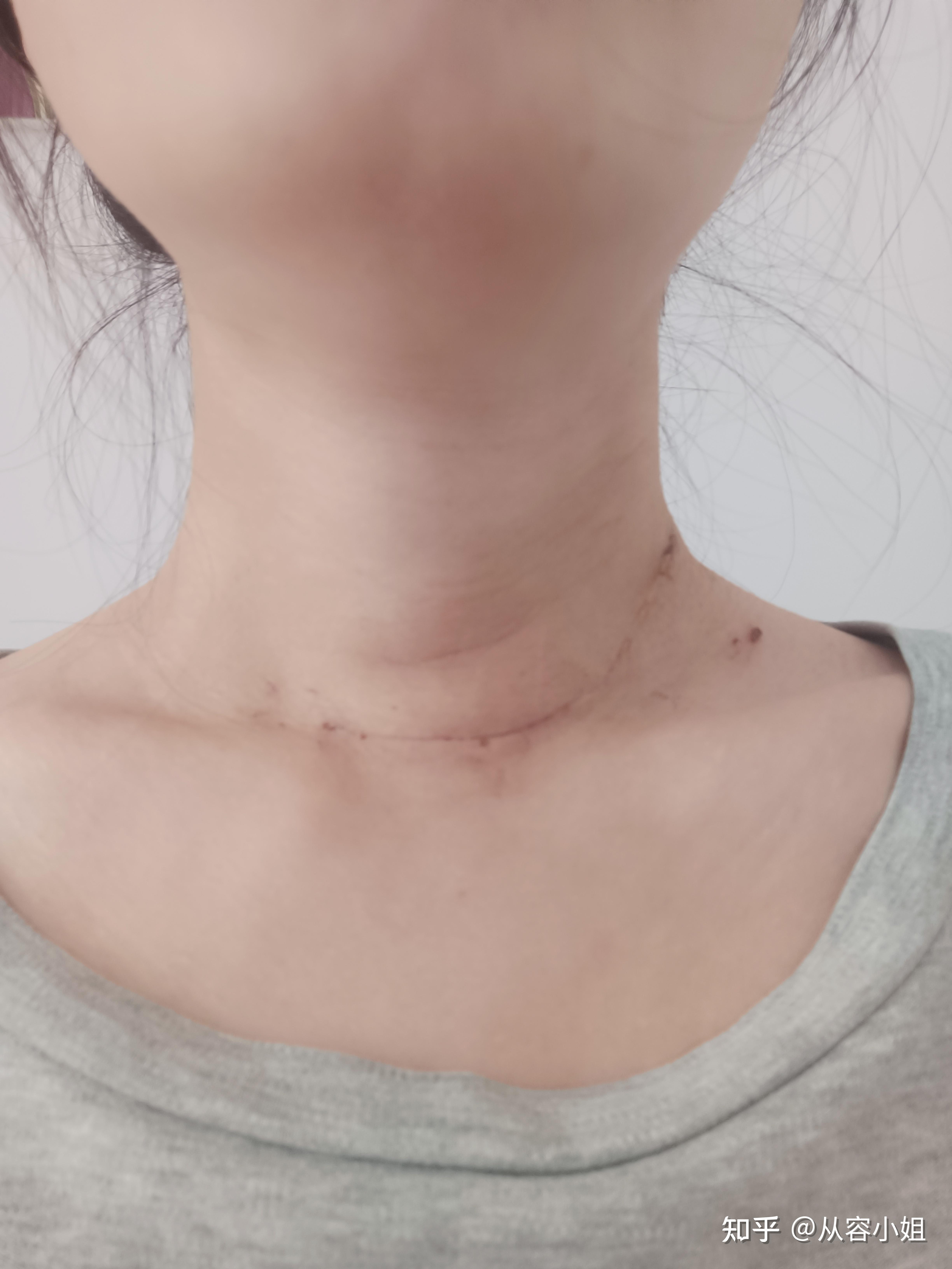 乳头状甲状腺癌的发现及治疗过程