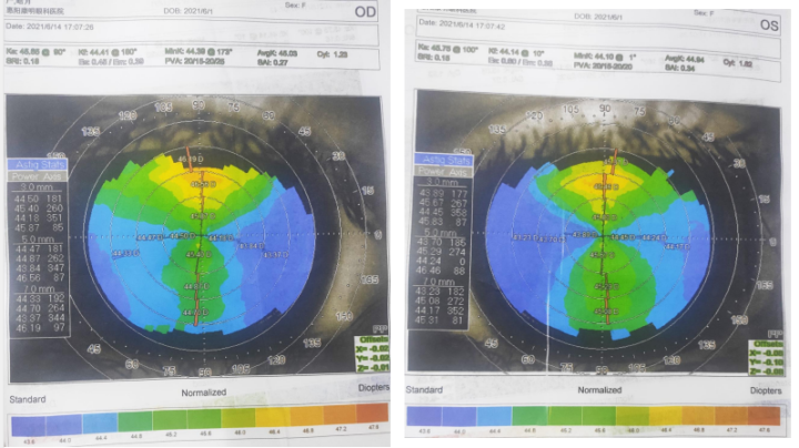 医院通常会让我们做角膜地形图,查看角膜水平方向和垂直方向的k1,k2