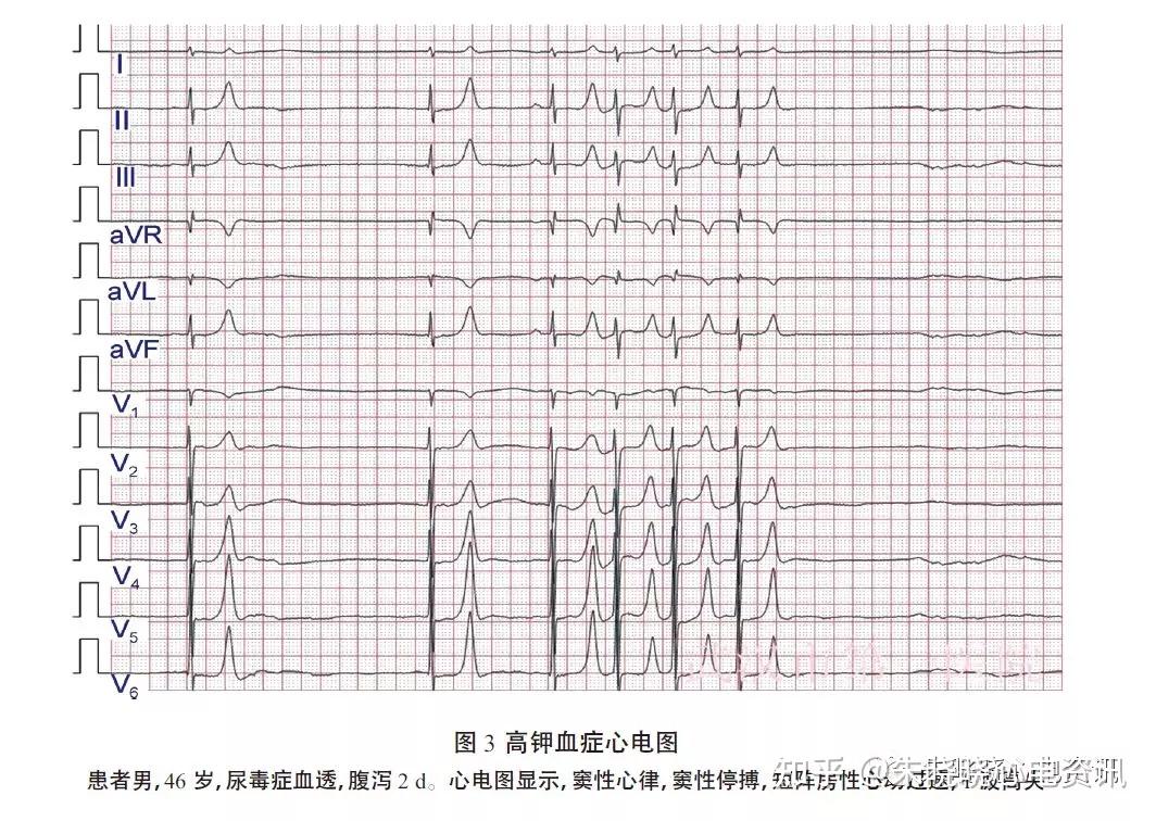 家兔高钾血症心电图图片