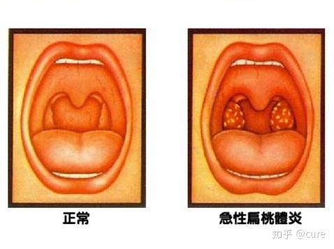 的淋巴濾泡組成詳細解釋人和兩棲類以上動物,鼻後孔的頂壁或咽與口腔