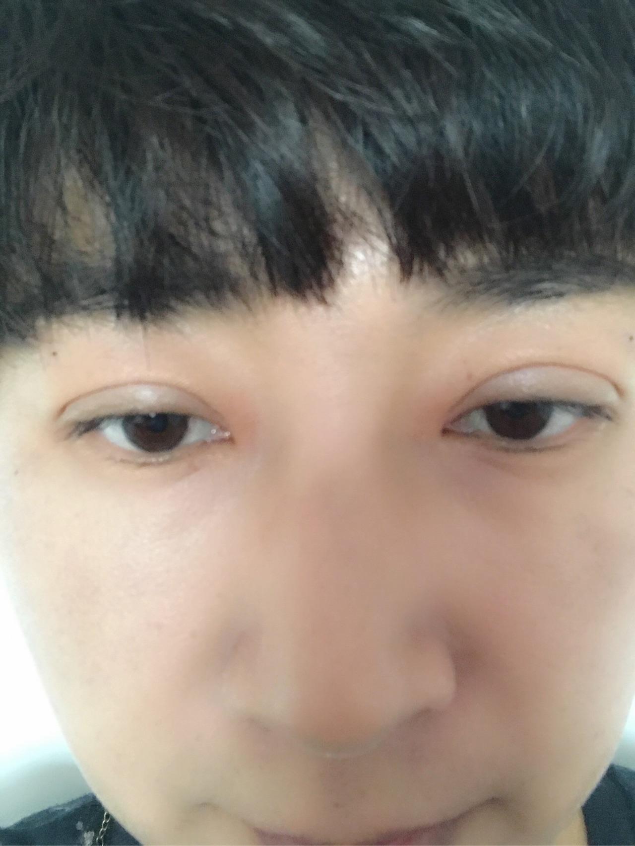 双眼皮纳米无痕埋线,将近6个月了,至今眼睛还有肉条感,本身近视眼