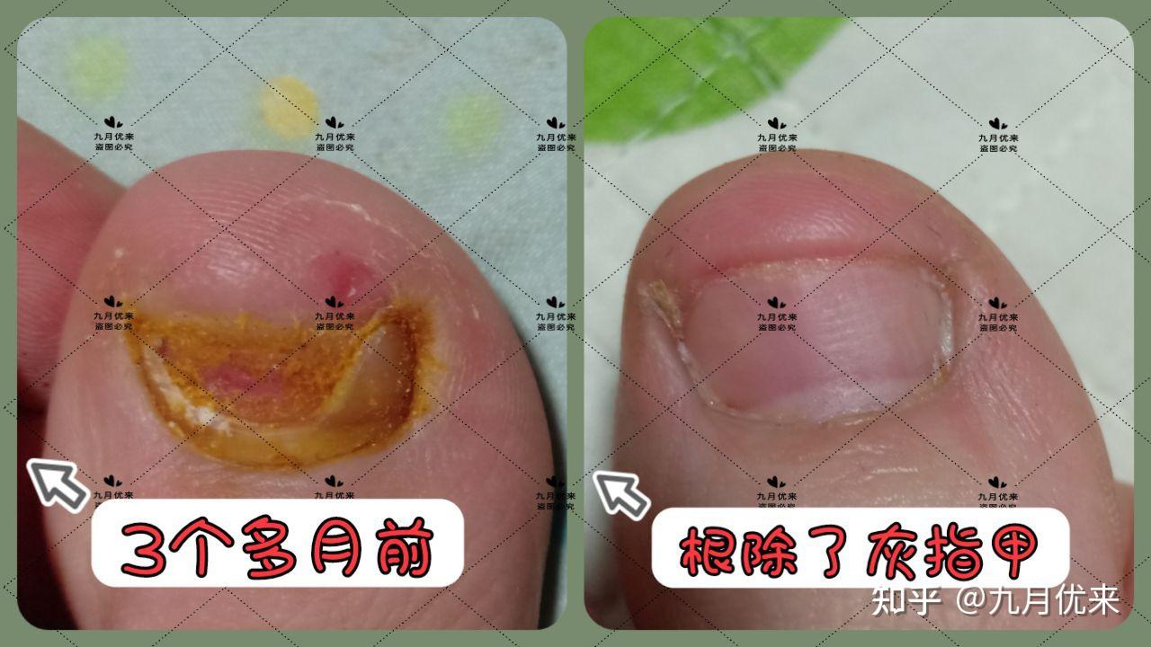 你还没根除灰指甲?