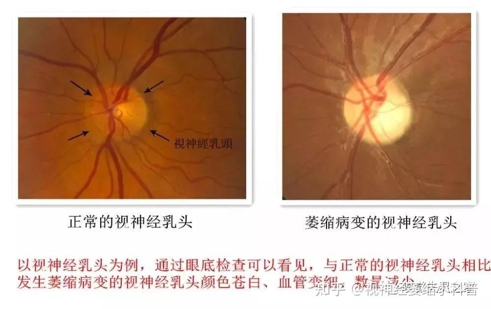 视神经萎缩不能治愈,但是可以药物治疗.