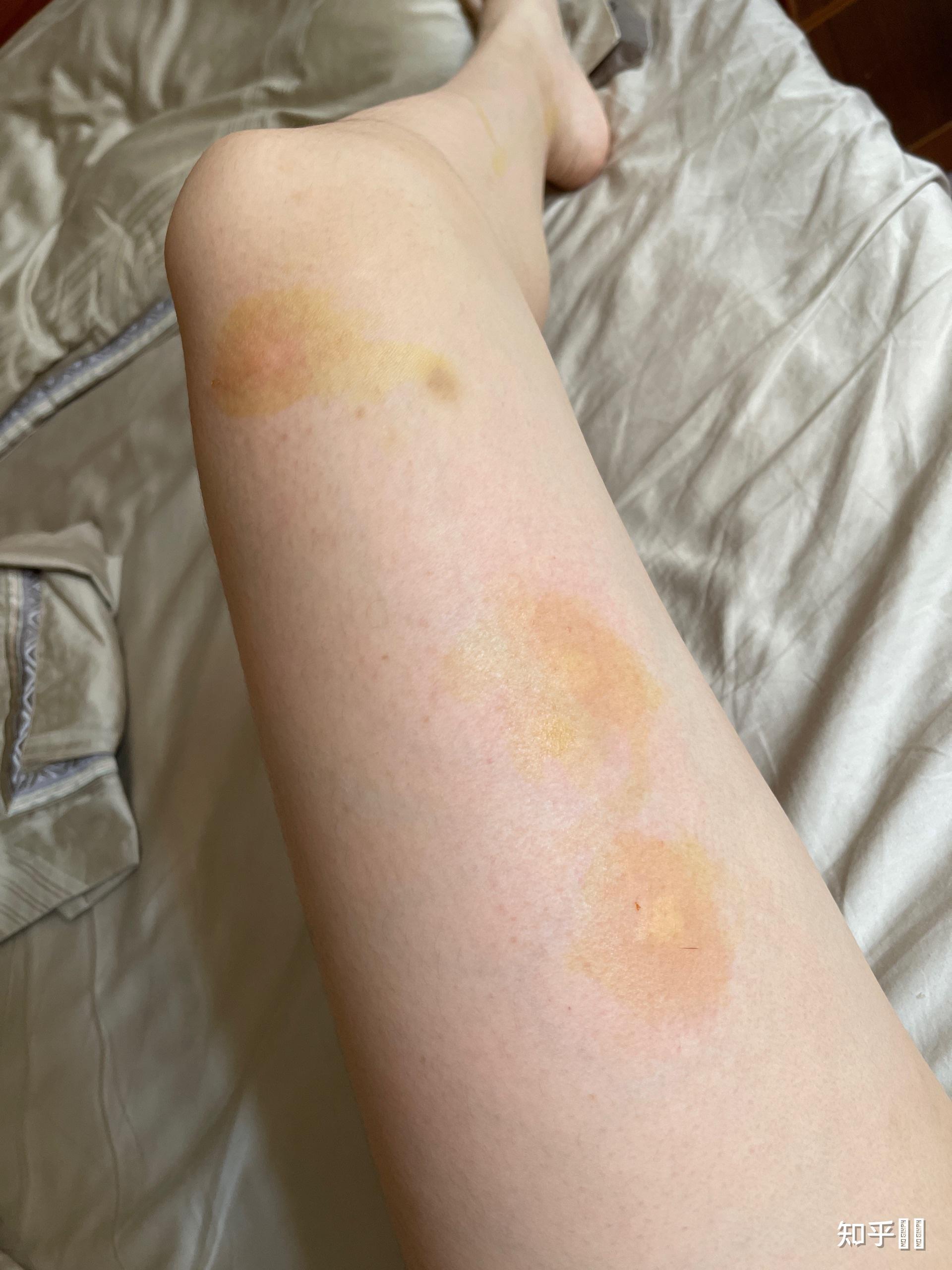 蚊子咬完就过敏怎么破