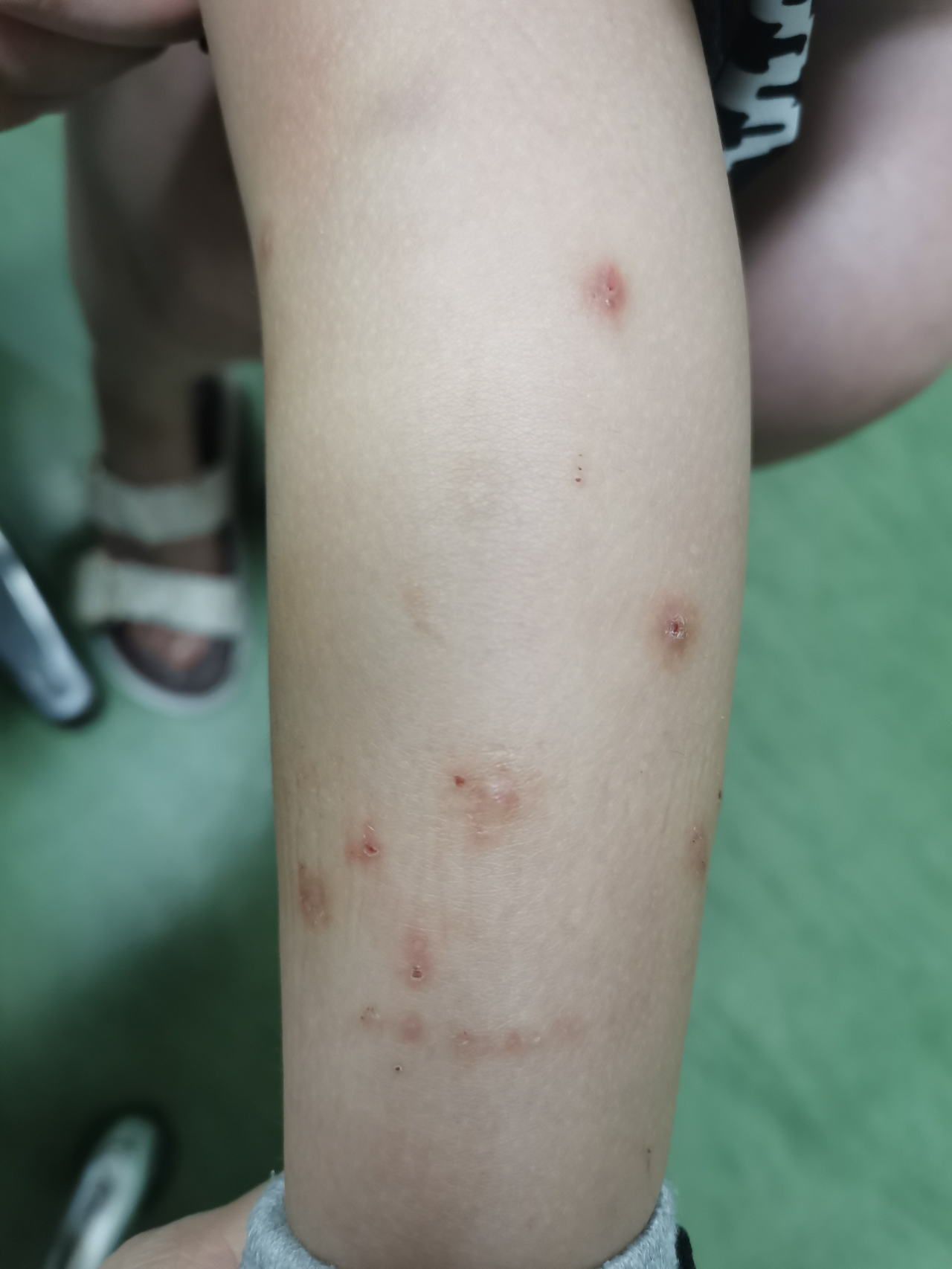 各种蚊子咬后症状图片图片