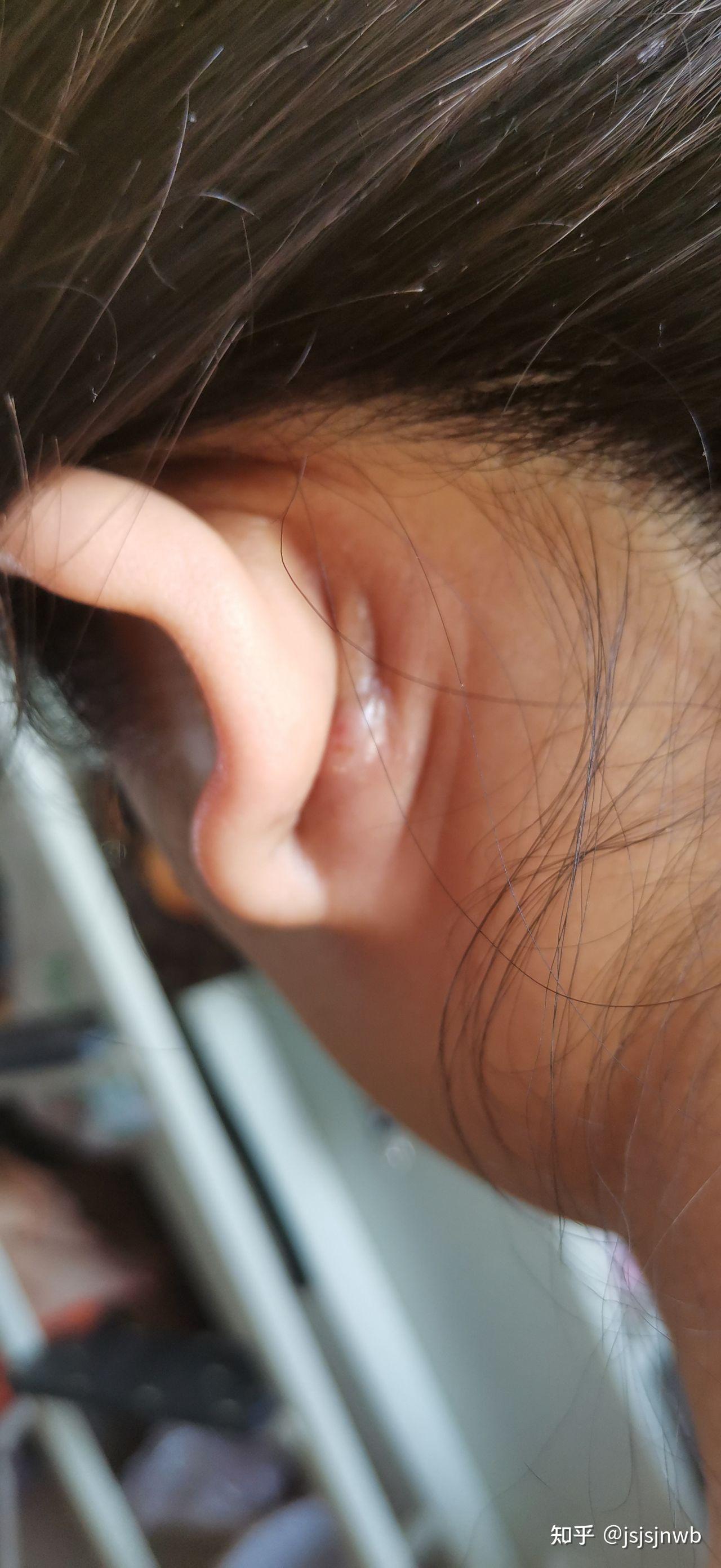 耳朵耳垂长出硬包怎么办？你有这样的情况吗？_哔哩哔哩_bilibili