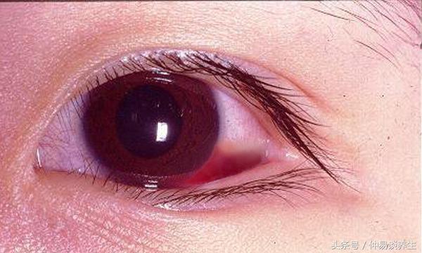 中医中药治疗白睛溢血眼球结膜下出血