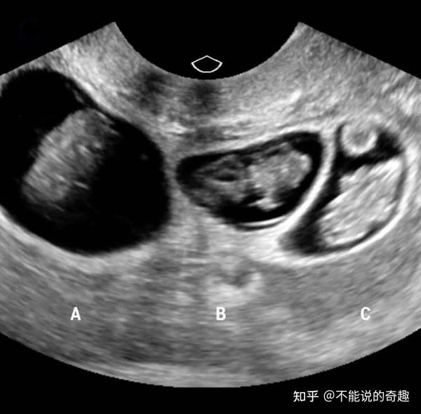 澳大利亚妈妈生完3孩子又生3胞胎,再来一双胞胎,生活拮据但幸福满满 - 知乎