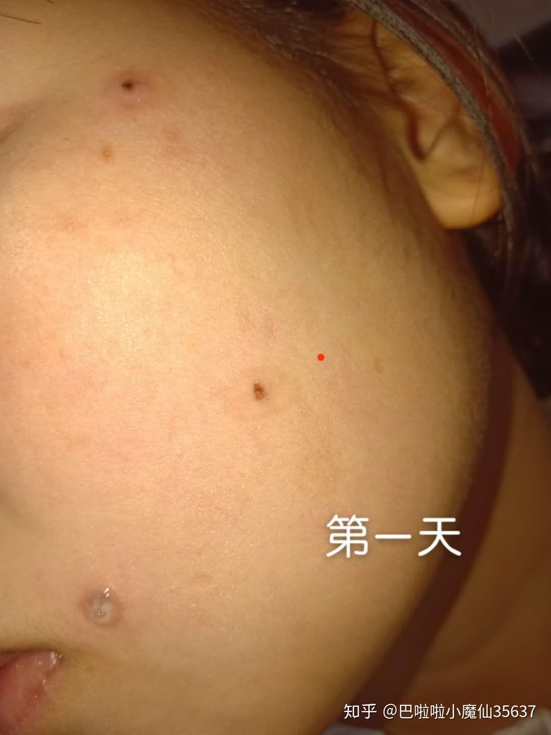 药水点痣 - 知乎