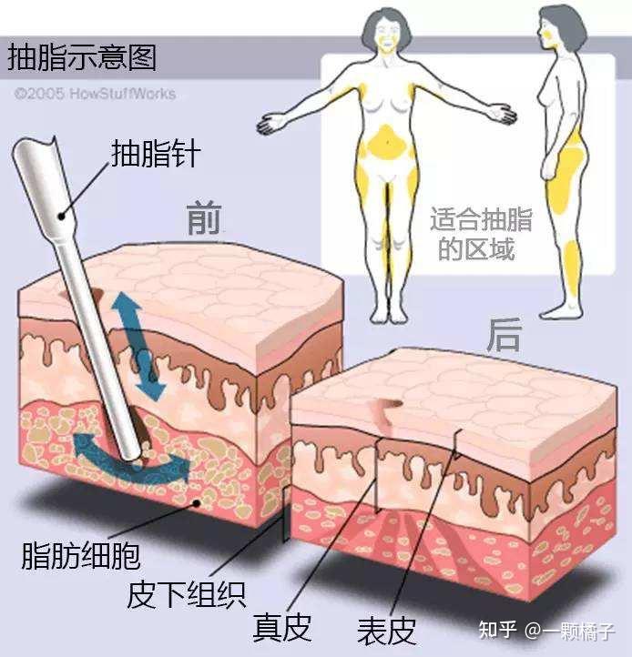 小腿脂肪分布图片