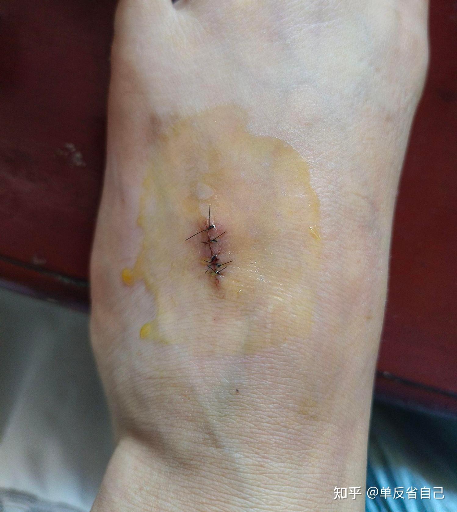 脚背上的血管瘤,终于下定决定去做手术.