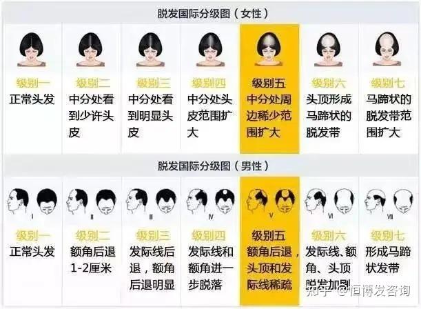 植发选择哪种形状(植发选择哪种形状最好)